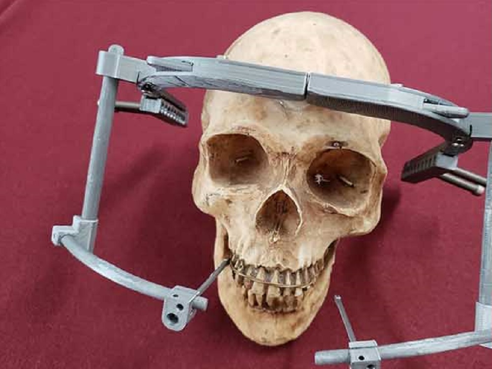 Crea IPN dispositivo mecánico impreso en 3D para corregir deformaciones craneales