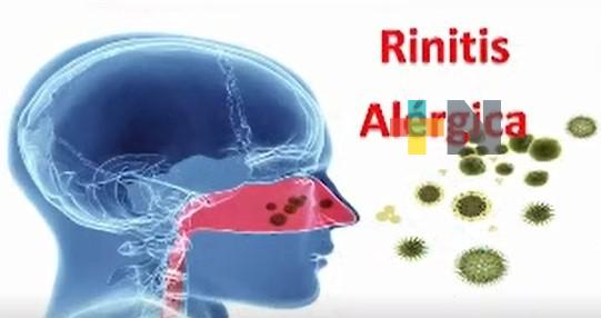 Rinitis alérgica afecta a casi la mitad de la población mexicana: INER