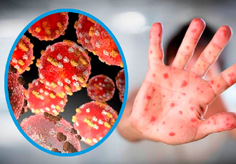 Bajan contagios de mpox en México; en los últimos 14 días confirman cuatro