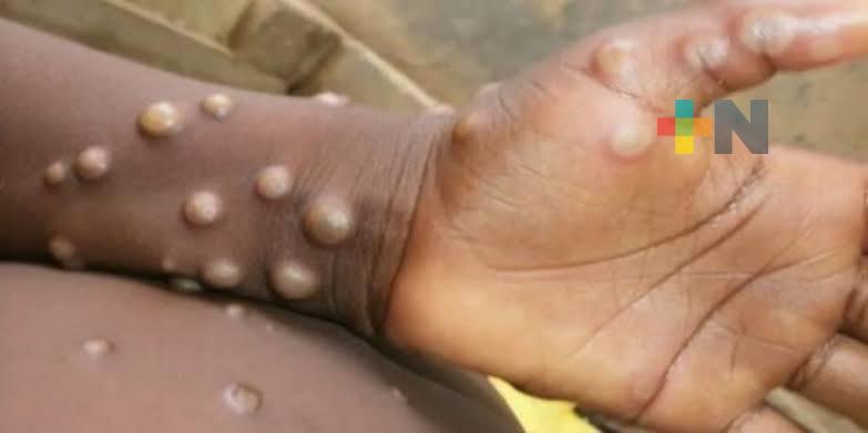 Sistema de vigilancia epidemiológica mantiene control sobre viruela símica