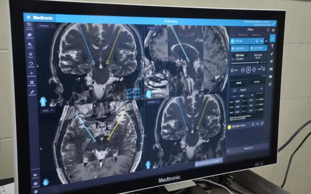 Estimulación cerebral profunda ayuda a pacientes con Parkinson