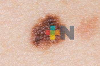 Advierte IMSS Veracruz Sur que cambios en lunares podrían ser melanoma