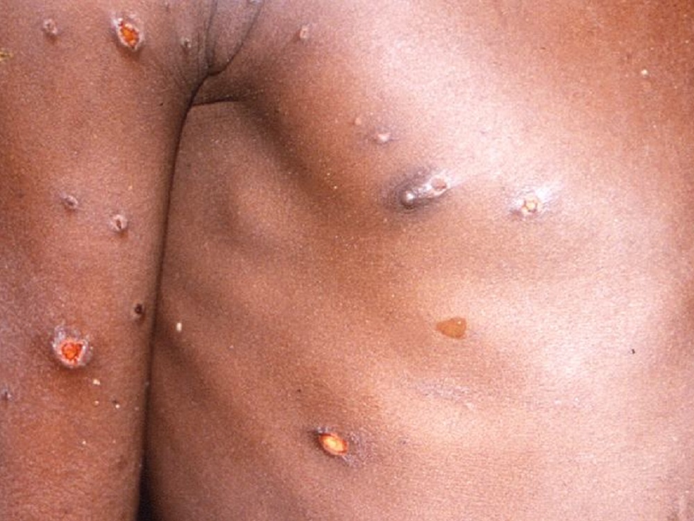 En Xalapa continúan con medidas sanitarias para evitar contagios de viruela del mono