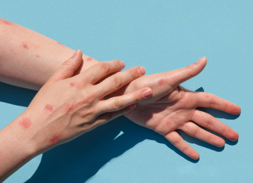 En México, curva epidémica de viruela símica mantiene tendencia de reducción