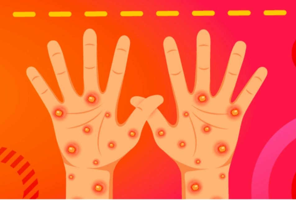 Secretaría de Salud confirma 386 casos de viruela símica y ninguna defunción