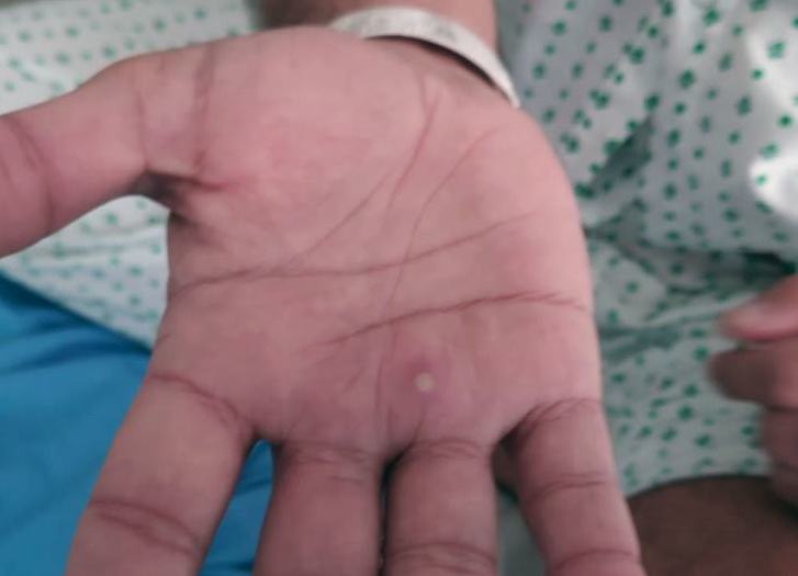Hombre de Misantla, quinto caso de viruela símica en el estado: Salud