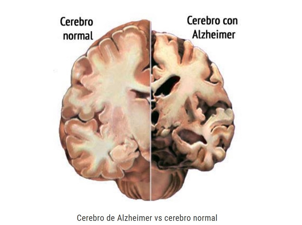 Alto consumo de grasas podría asociarse con Alzheimer