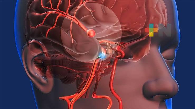 Atiende ISSSTE de Coatza hasta ocho pacientes con problemas cerebrovasculares