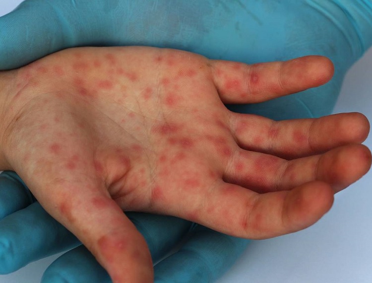 Inicia capacitación sobre detección y atención de mpox para profesionales de la salud en México