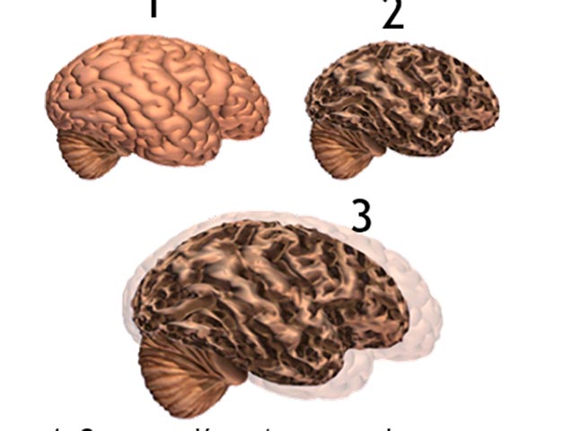 UV estudia probable relación de COVID-19 con Alzheimer