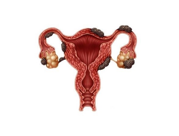 En México, una de cada 10 mujeres en edad reproductiva puede padecer endometriosis
