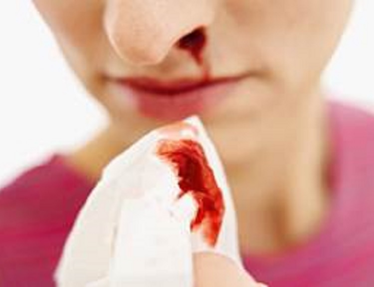 Sangrado frecuente en fosas nasales y articulaciones, algunos síntomas de hemofilia