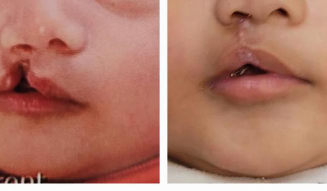 Hospital General de México suma 50 cirugías reconstructivas a infantes con labio y paladar hendido