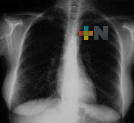En zona Veracruz-Boca del Río van en aumento los casos de fibrosis pulmonar
