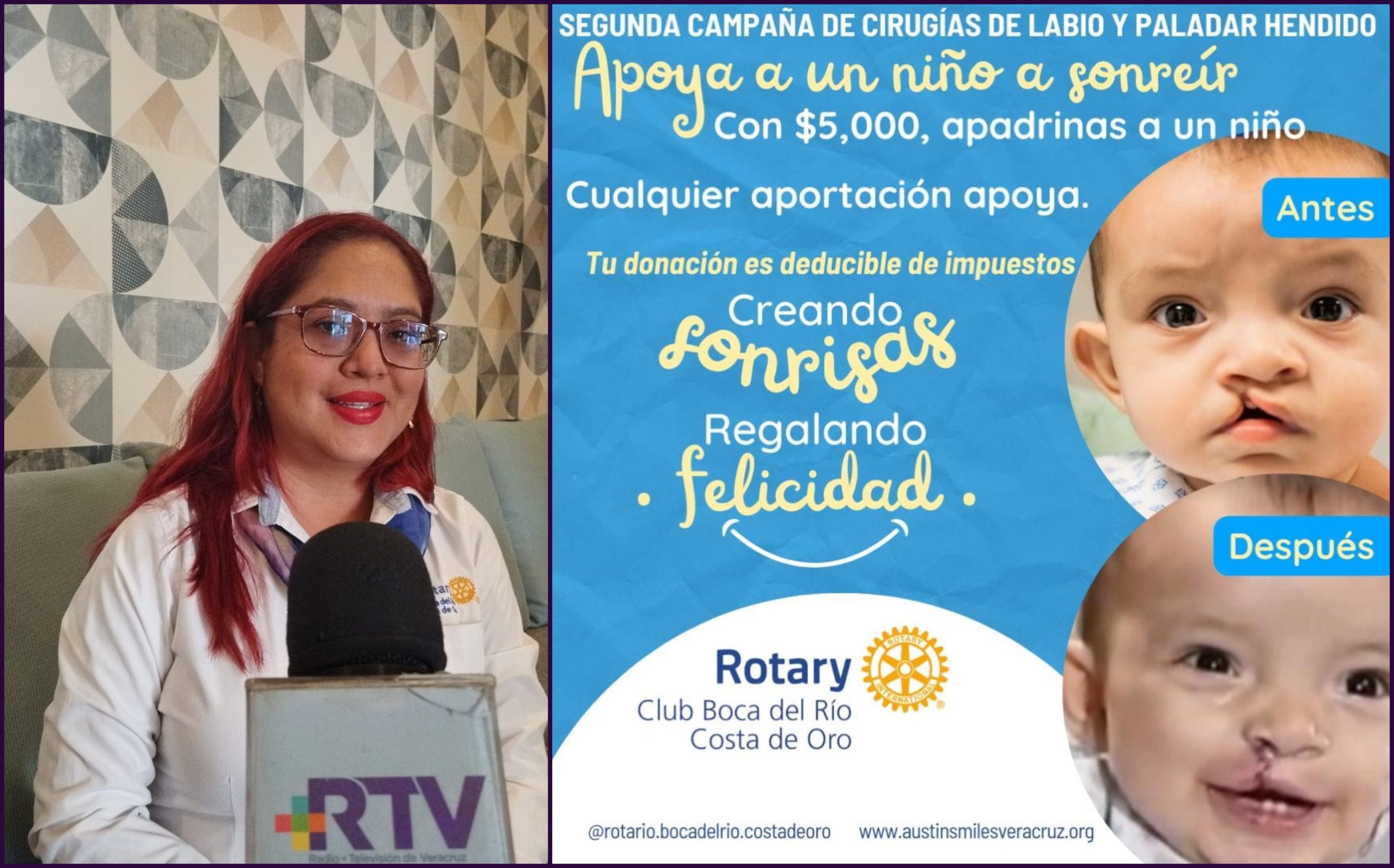 Club Rotario convoca a segunda campaña de cirugías de labio y paladar hendido