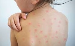 IMSS exhorta a tomar medidas y prevenir sarampión