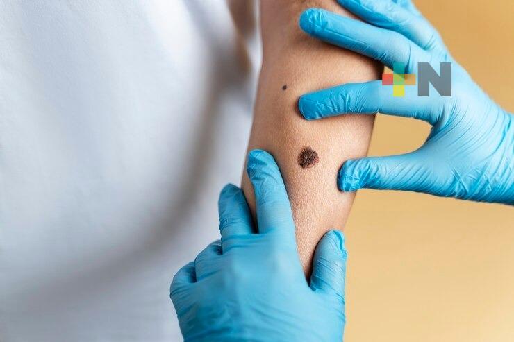 IMSS región sur advierte sobre riesgo de cáncer de piel por exposición prolongada al sol