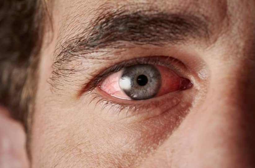 Enfermedad de Coats, patología de la visión que afecta principalmente a varones