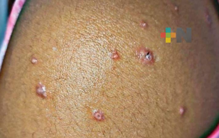 Sin reportes de viruela símica en Coatzacoalcos
