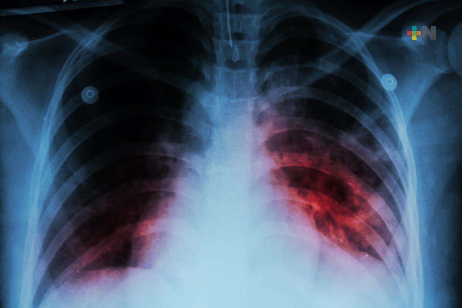 En Veracruz aumenta casos de pacientes con tuberculosis