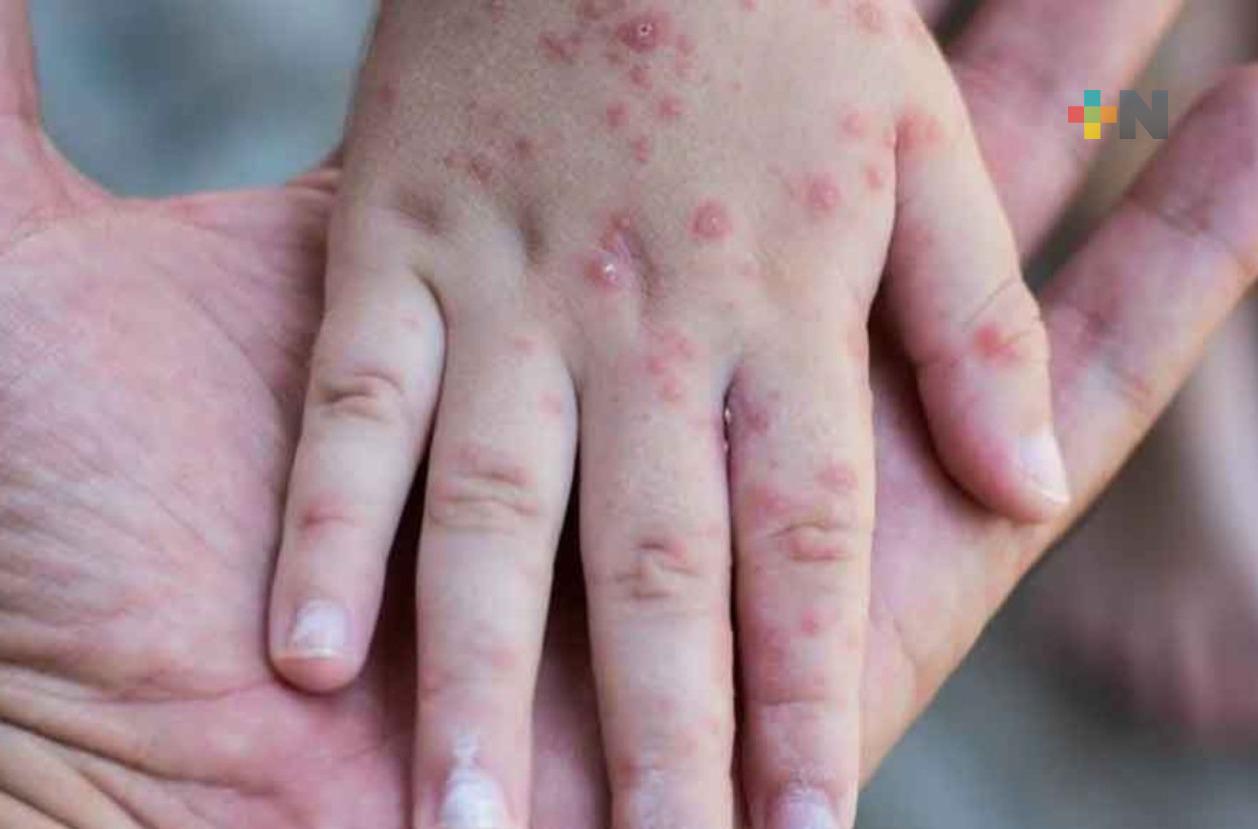 Ante alerta de salud por casos de sarampión exhortan a vacunarse