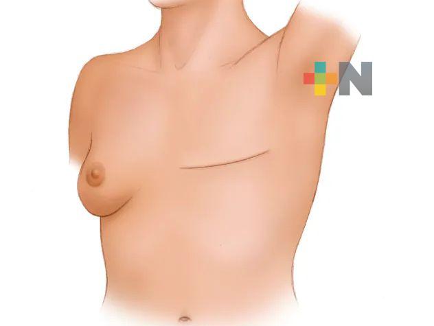 Recuperar la autoestima, un proceso complejo para mujeres sobrevivientes de cáncer de mamá