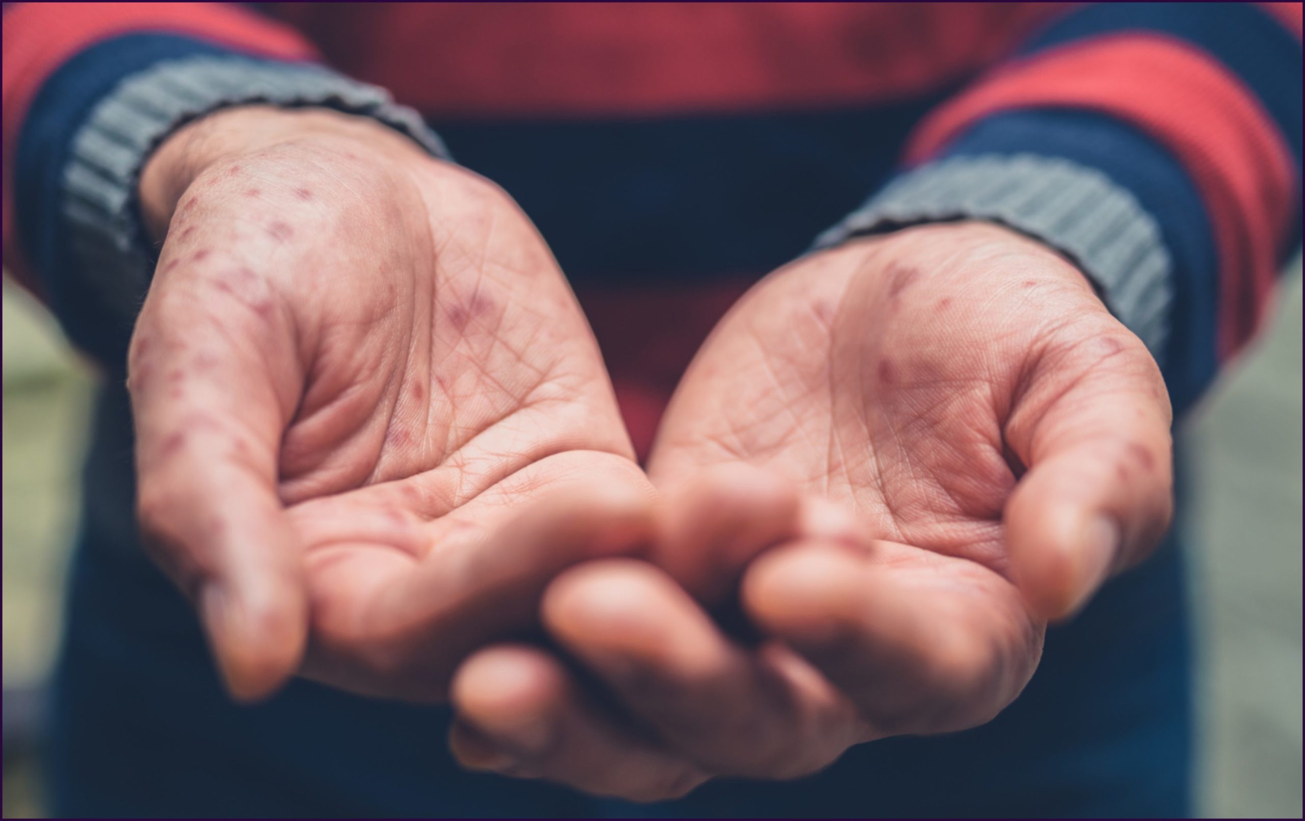 Virus Coxsackie se está presentando en guarderías y primarias