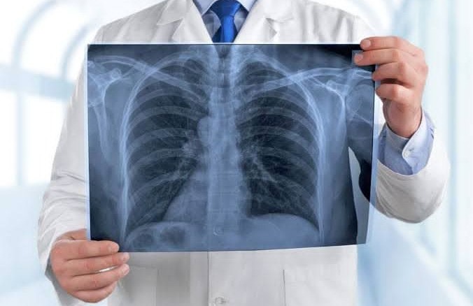 IMSS Coatzacoalcos llama a prevenir y detectar a tiempo la neumonía