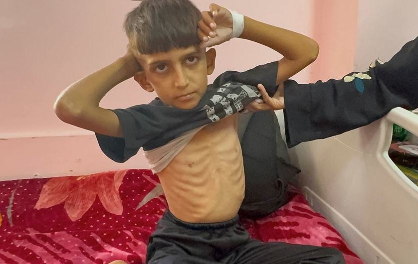Desnutrición infantil en Gaza sigue en niveles “asombrosamente altos”