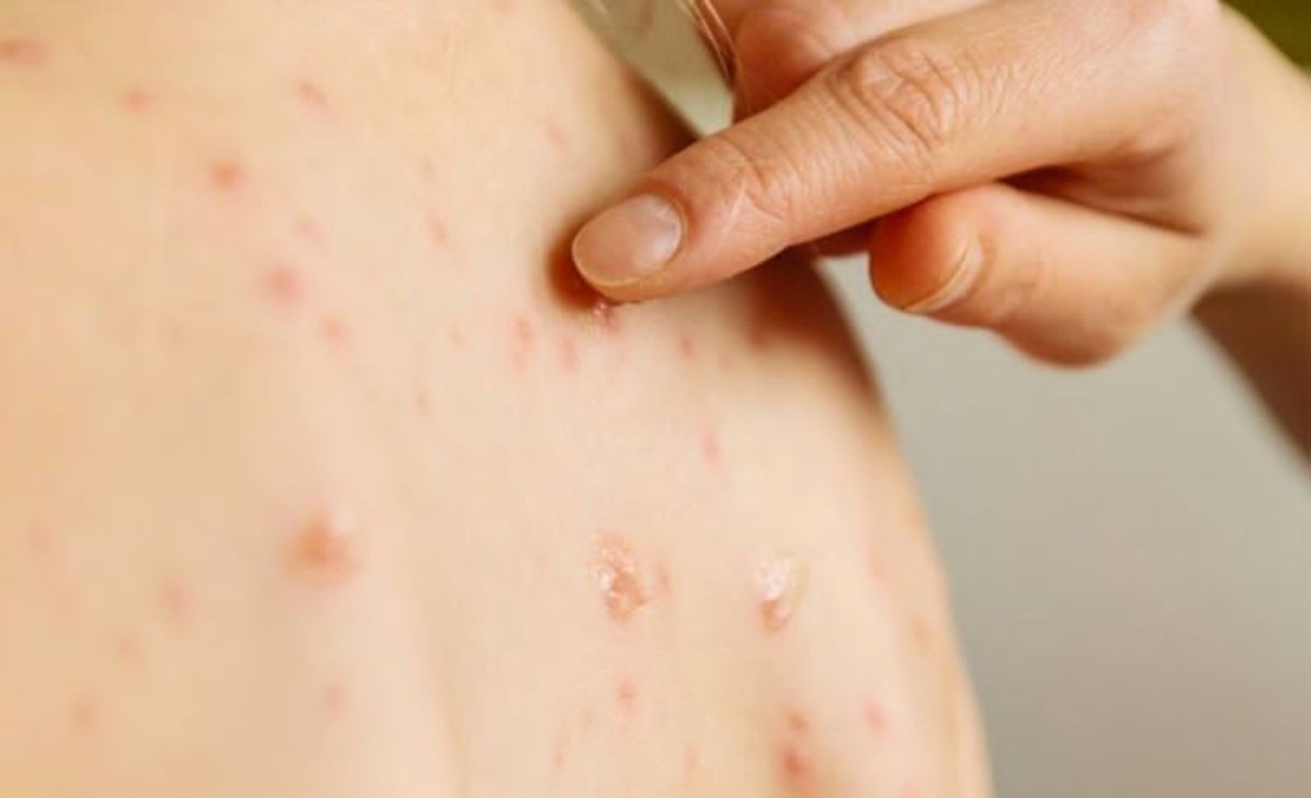 IMSS exhorta a identificar síntomas por herpes zóster