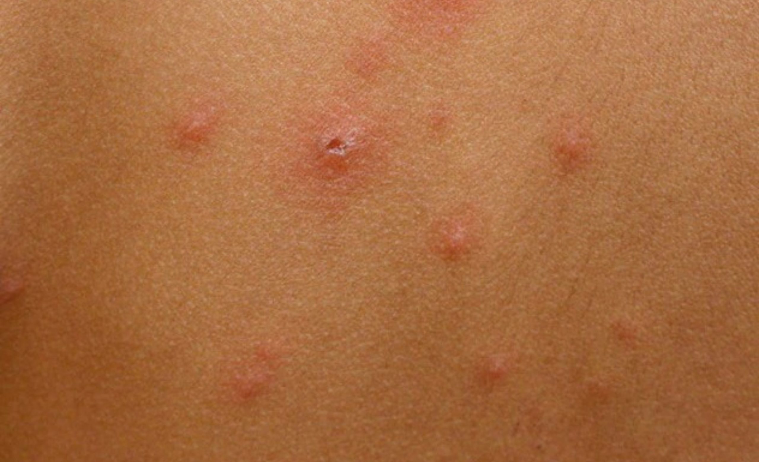 IMSS informa medidas de prevención ante casos de varicela