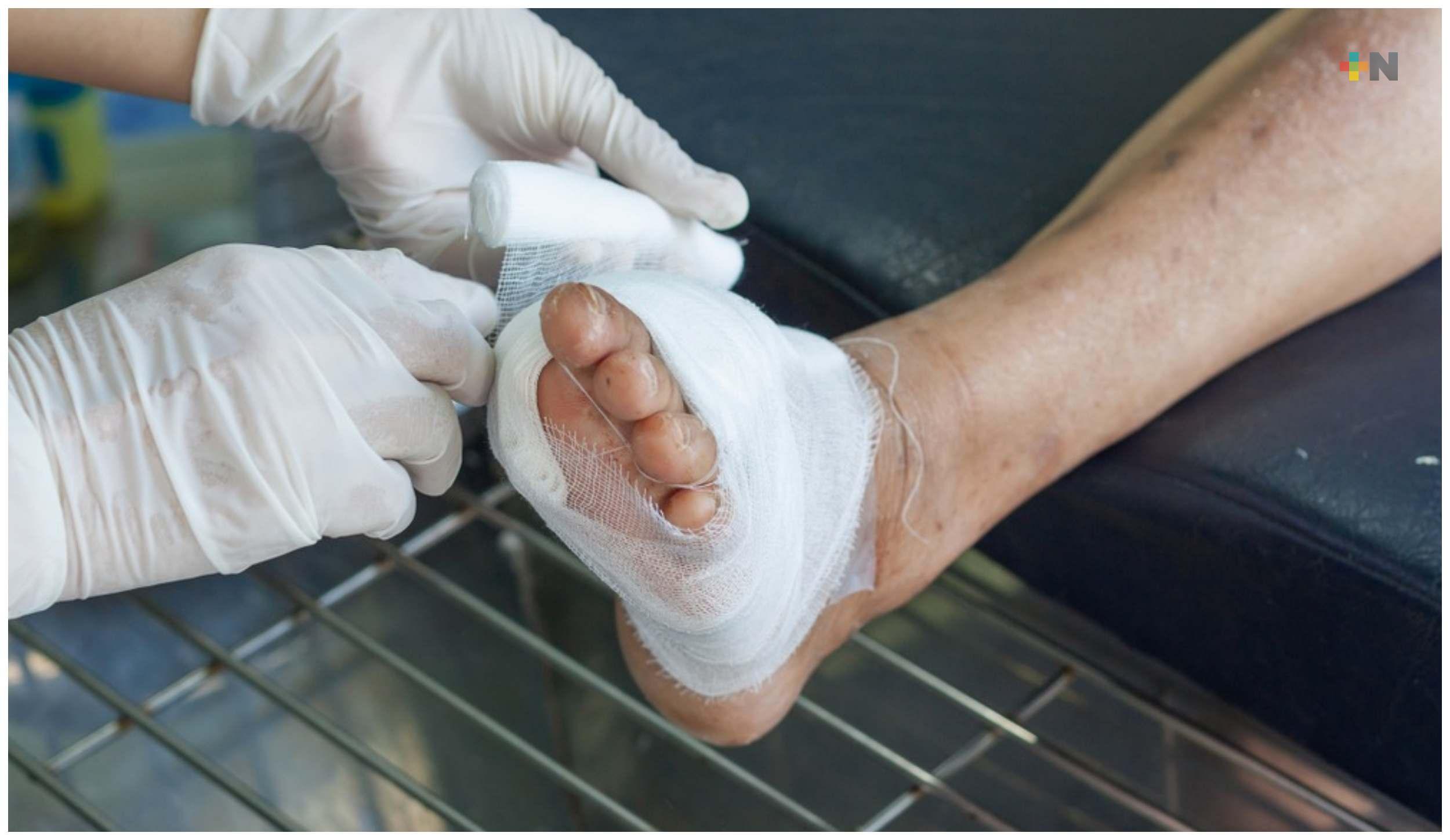 Especialistas advierten sobre el cuidado de heridas en pies de pacientes diabéticos