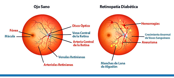 En desarrollo, gotas oftálmicas para prevenir la pérdida de visión en personas con diabetes