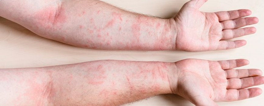 Alergias afectan vida de miles de personas