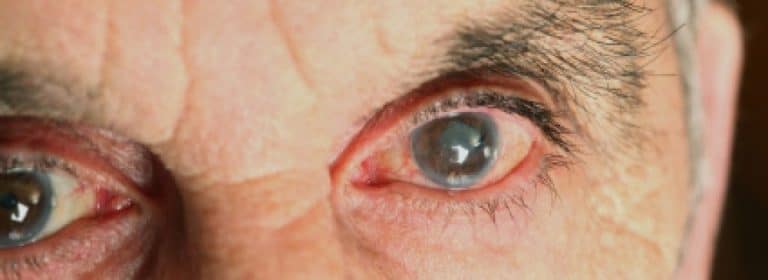 Glaucoma, segunda causa de ceguera en el mundo. Conoce sus mitos y realidades